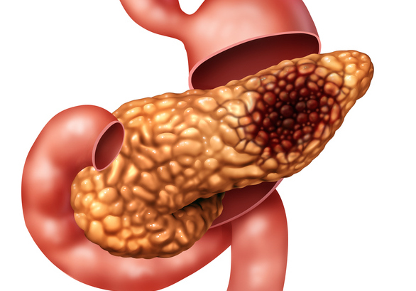 Study Unveils Clues to the Pre-Metastatic Liver Environment in Pancreatic Cancer